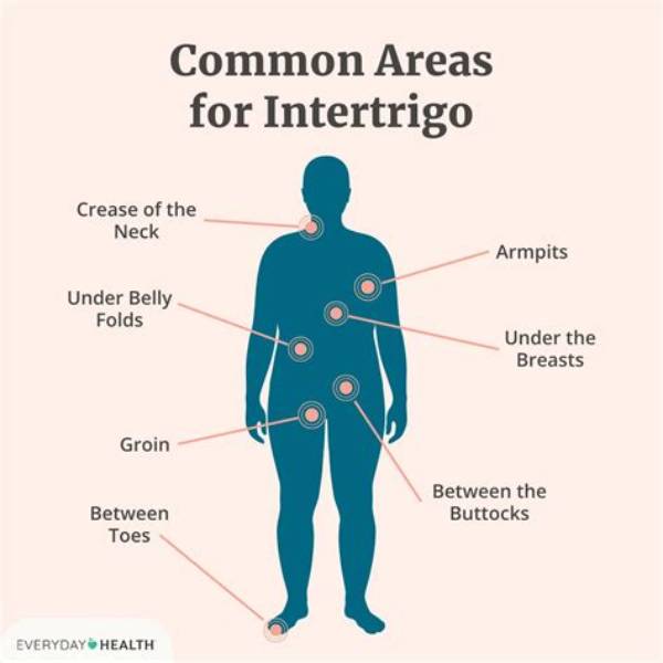 Why Does Intertrigo Flare up?