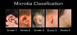 Why Does Microtia Happen?