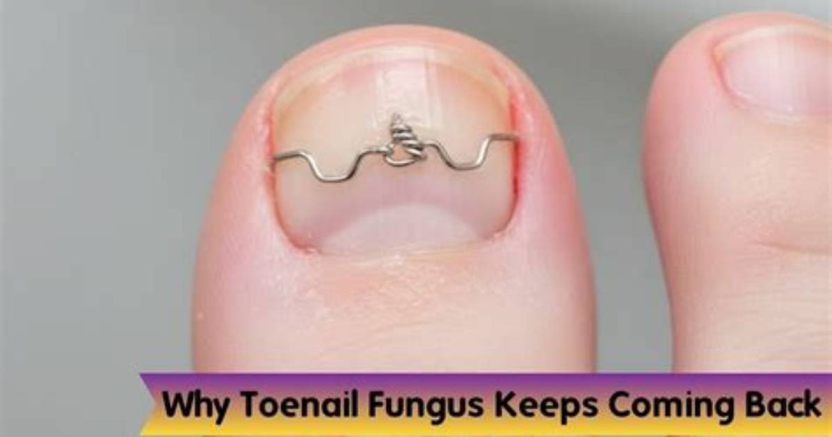 Why Does Toenail Fungus Keep Coming Back?
