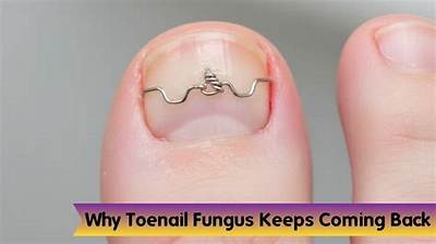Why Does Toenail Fungus Keep Coming Back?