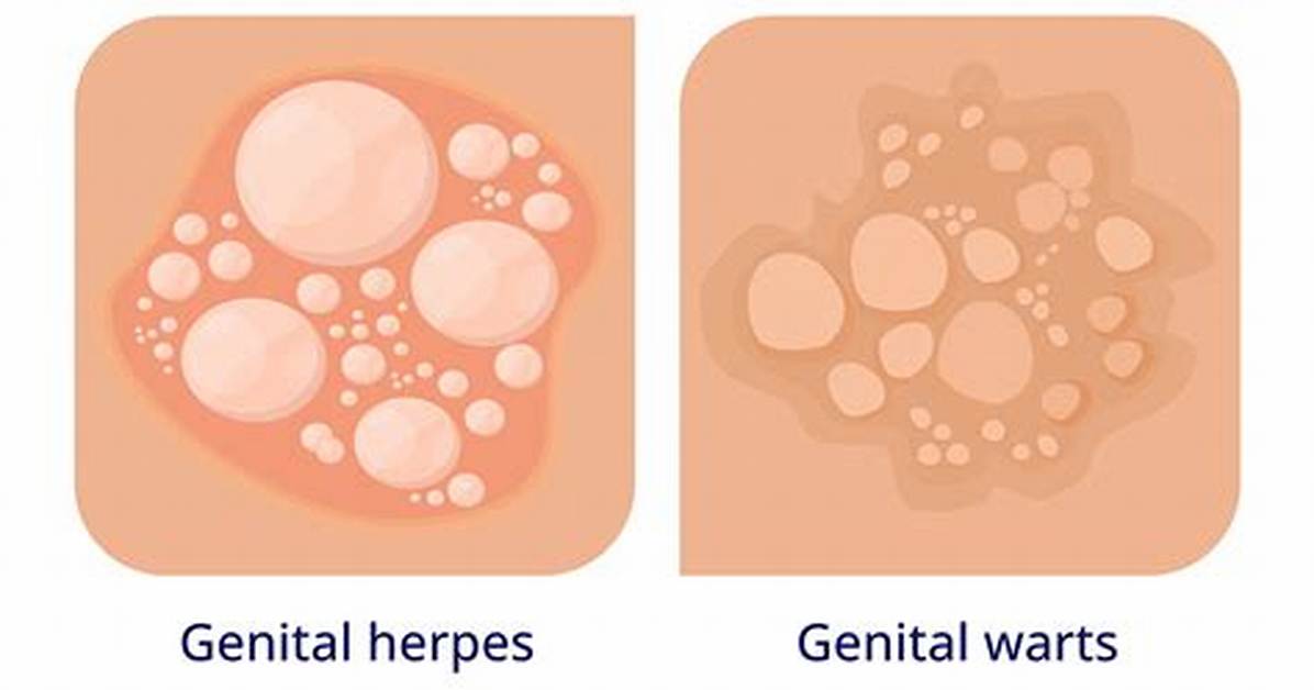 Why Genital Warts Itch?