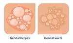 Why Genital Warts Itch?