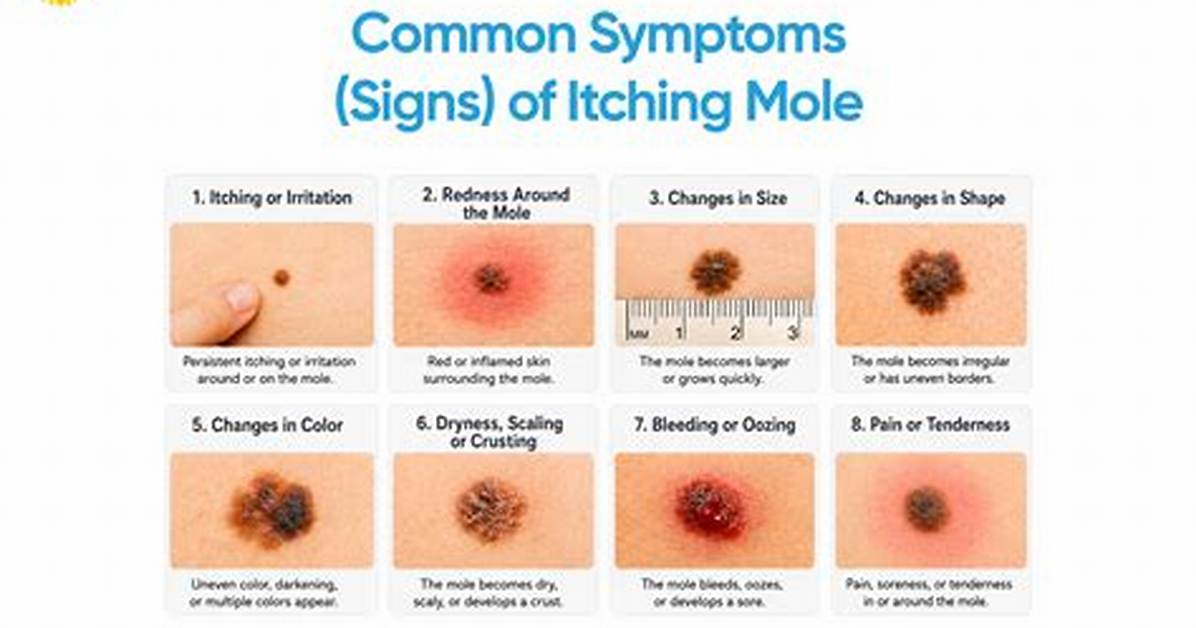 Why Is My Mole Raised and Itchy?