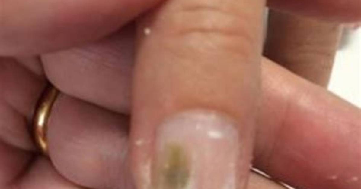 Why Is My Nail Green?