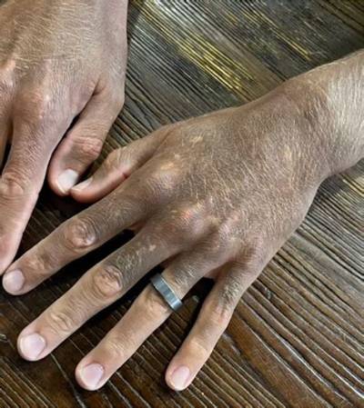 Why Is My Skin Turning Black After Surgery?