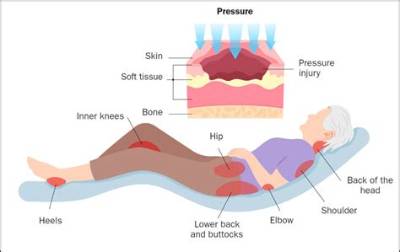 Why Is Pressure Area Care Important?