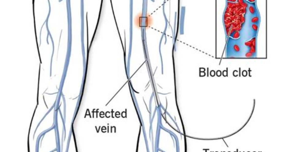 Why Order a Venography?