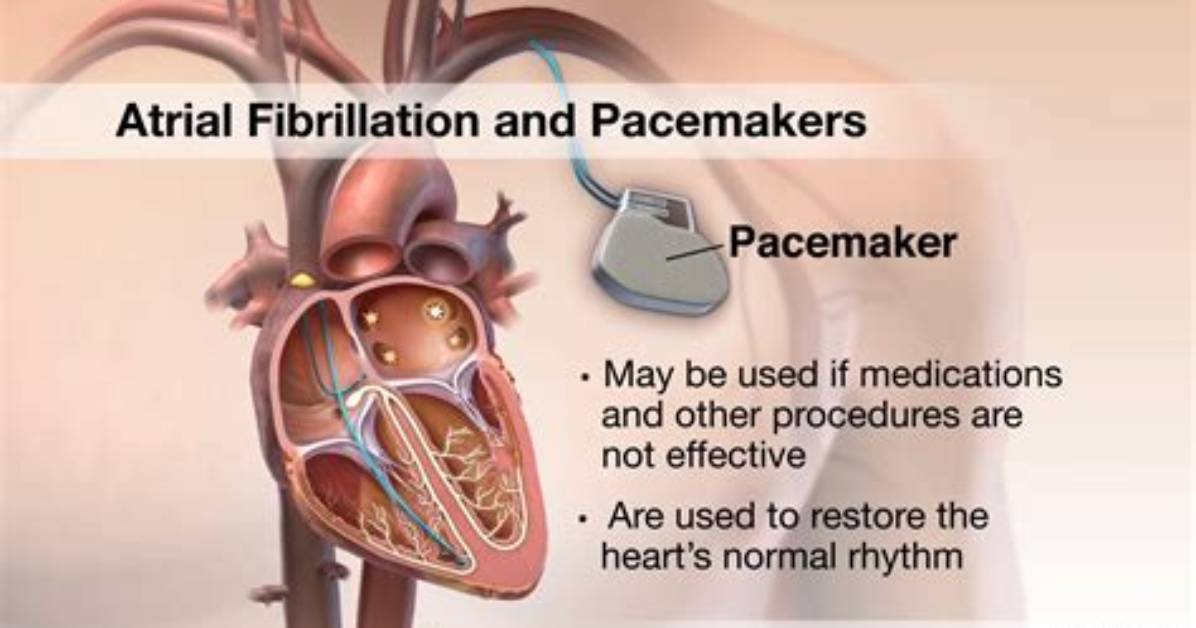 Will a Pacemaker Help Afib?