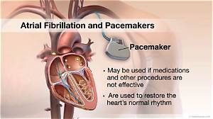 Will a Pacemaker Help Afib?