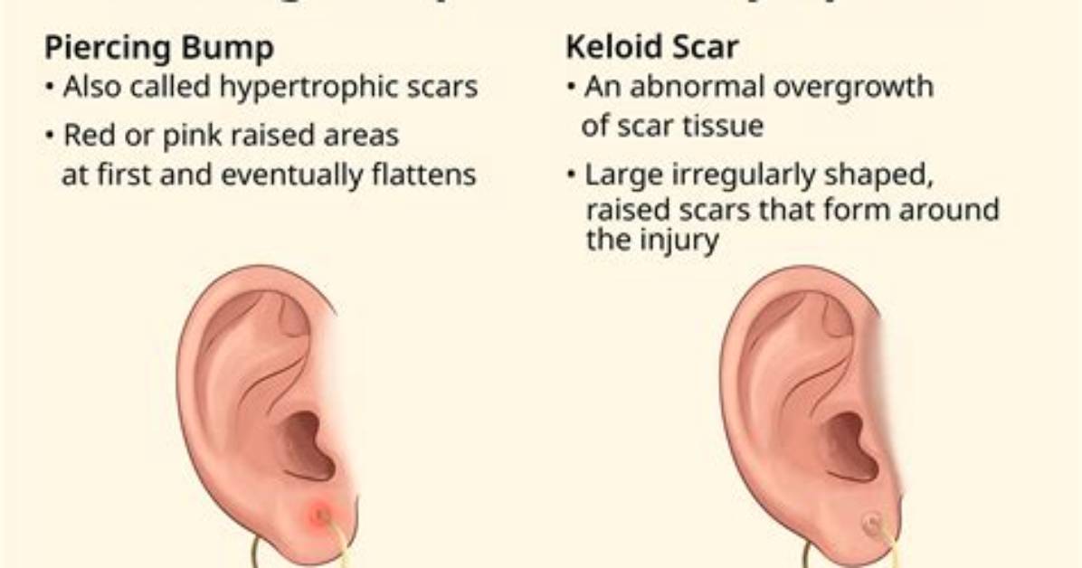 Will a Piercing Keloid Go Away?