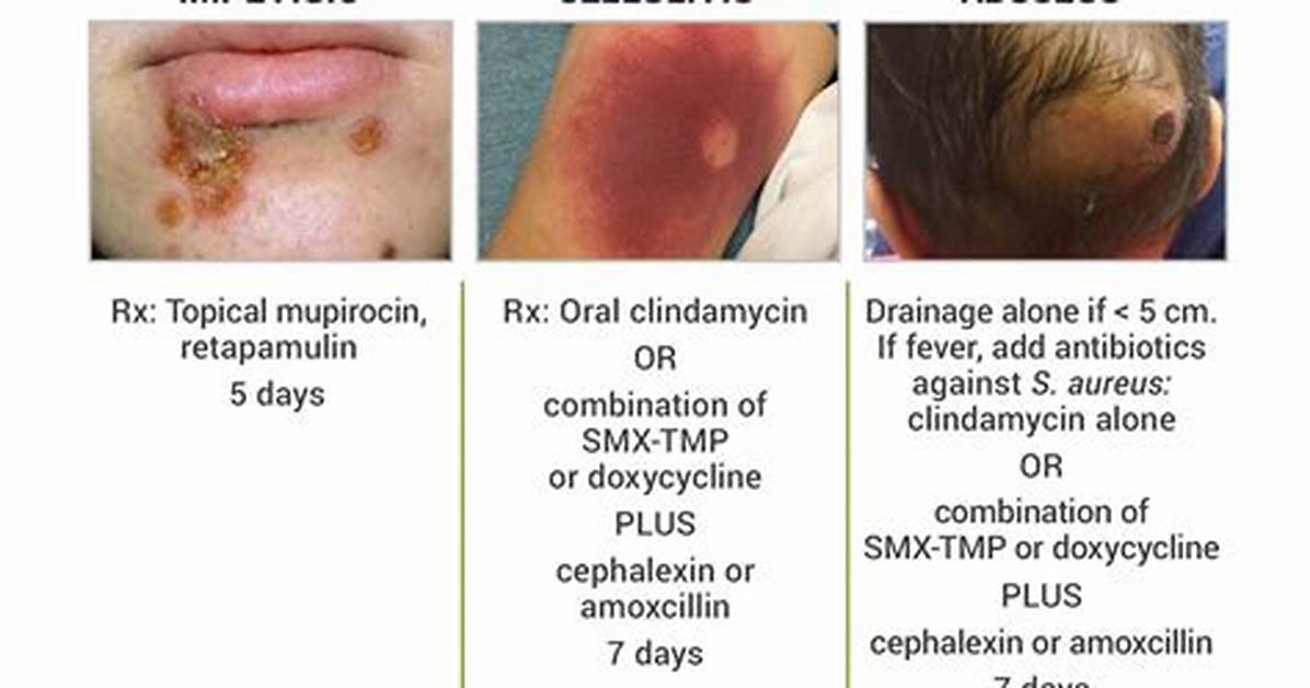 Will Amoxicillin Treat Skin Abscess?
