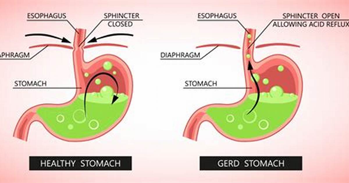 Will Eggs Cause Acid Reflux?