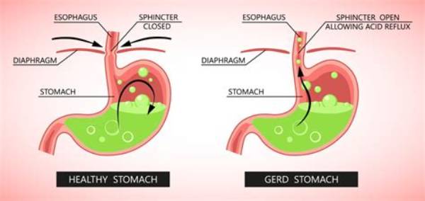 Will Eggs Cause Acid Reflux?
