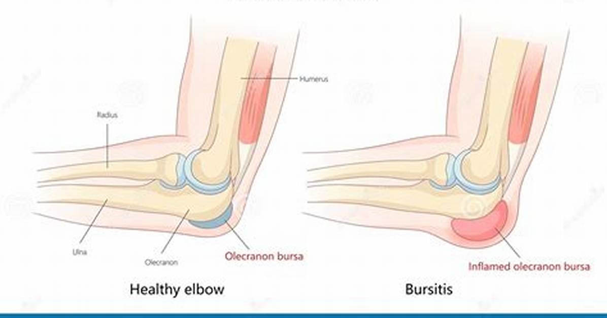 Will Elbow Bursitis Go Away by Itself?