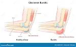 Will Elbow Bursitis Go Away by Itself?