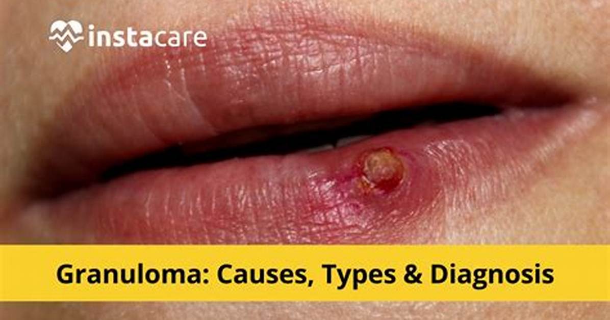 Will Granulomas Go Away?
