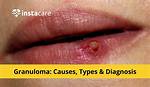 Will Granulomas Go Away?