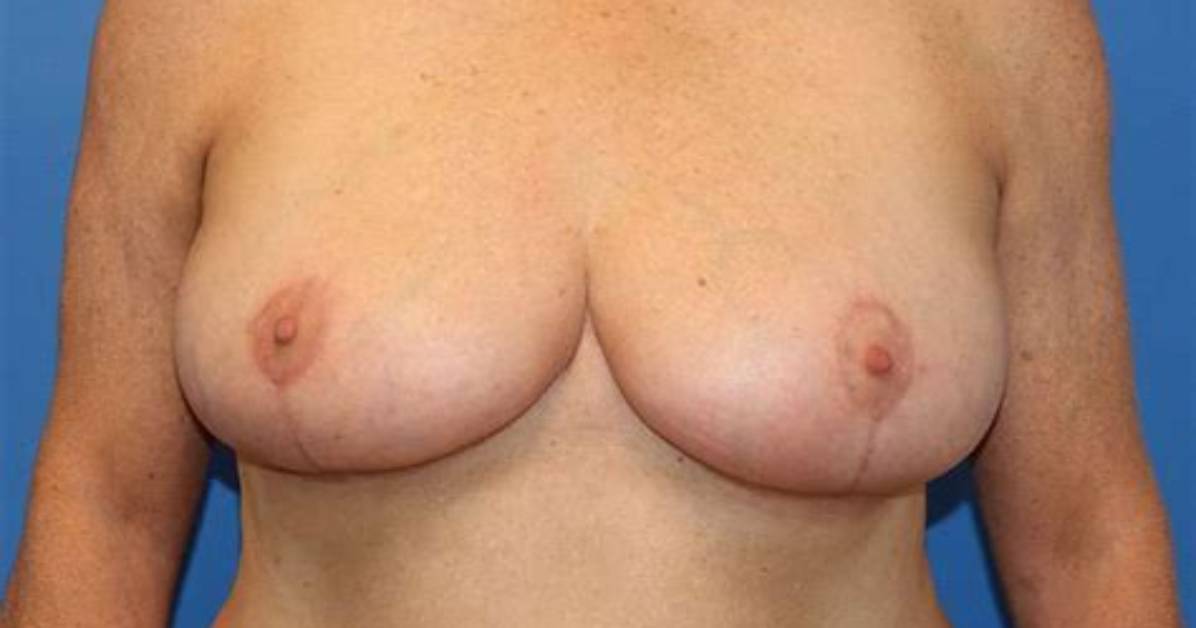 Will Insurance Cover Tubular Breast Reconstruction?
