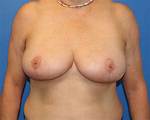 Will Insurance Cover Tubular Breast Reconstruction?