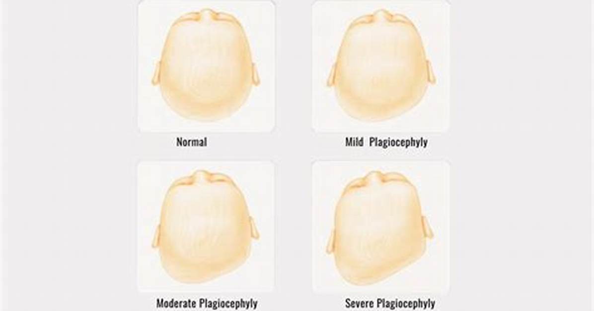 Will Misshapen Head Correct Itself?