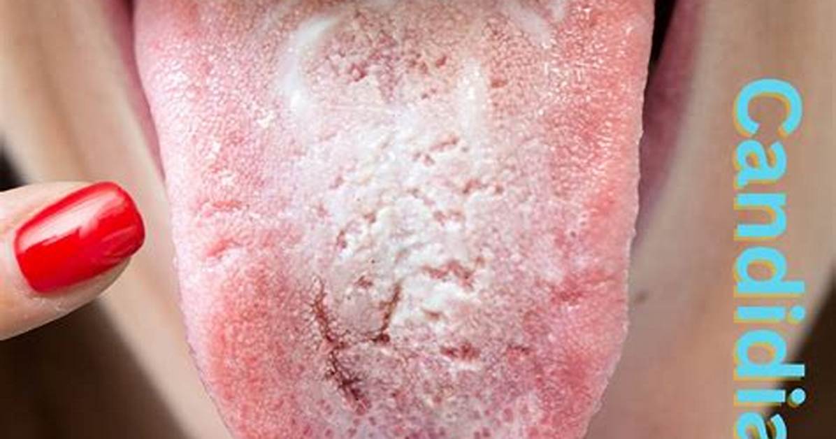 Will Oral Thrush Wipe off?