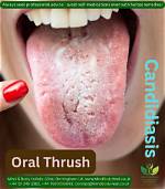 Will Oral Thrush Wipe off?