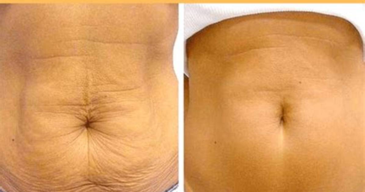 Will Sagging Skin Go Away After Weight Loss?