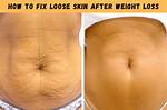 Will Sagging Skin Go Away After Weight Loss?