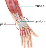 Will Tendons Heal on Their Own? Find out the Truth