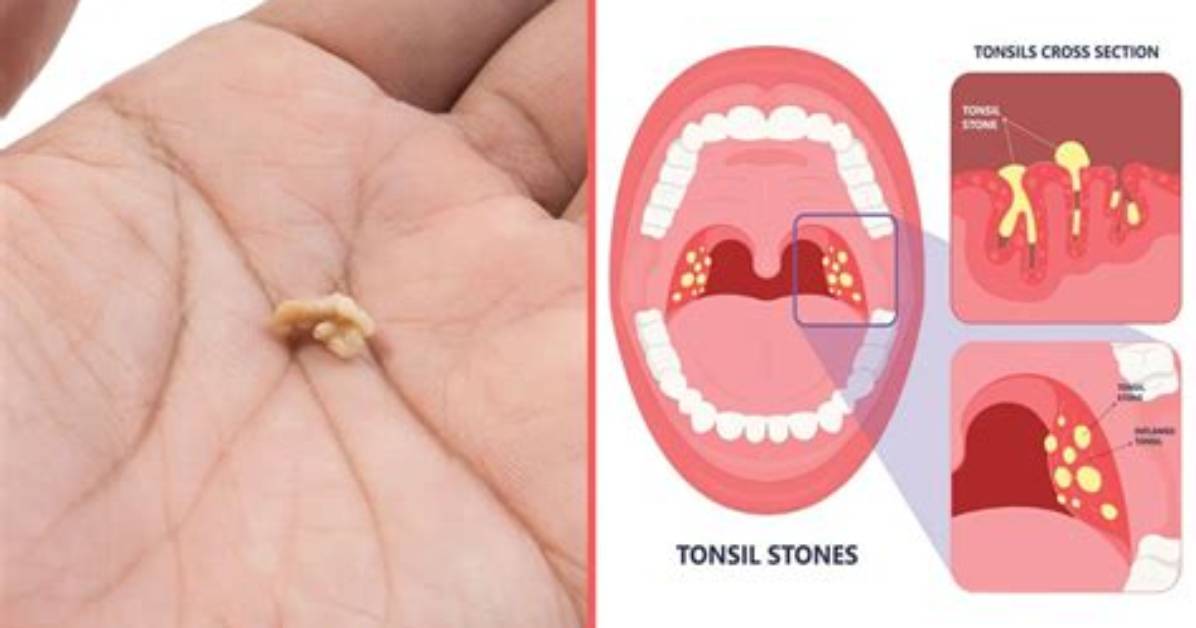 Will Tonsil Stones Ever Stop?