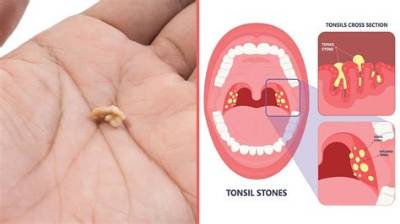 Will Tonsil Stones Ever Stop?