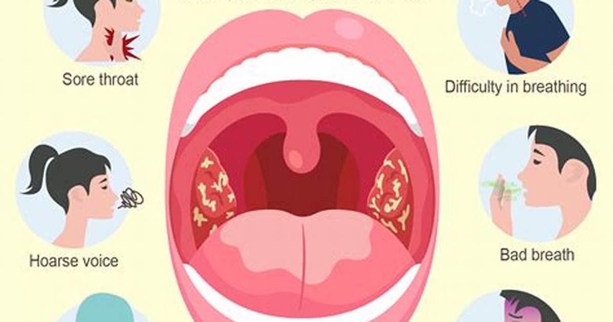 Will Tonsillitis Clear on Its Own?