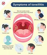 Will Tonsillitis Clear on Its Own?
