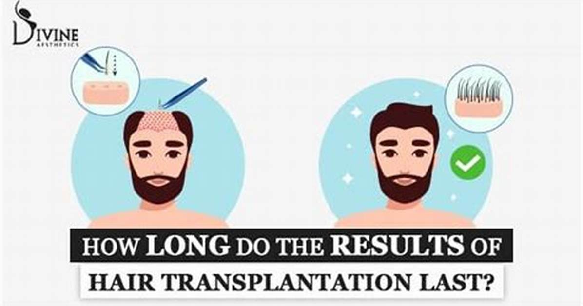 Will Transplanted Hair Last