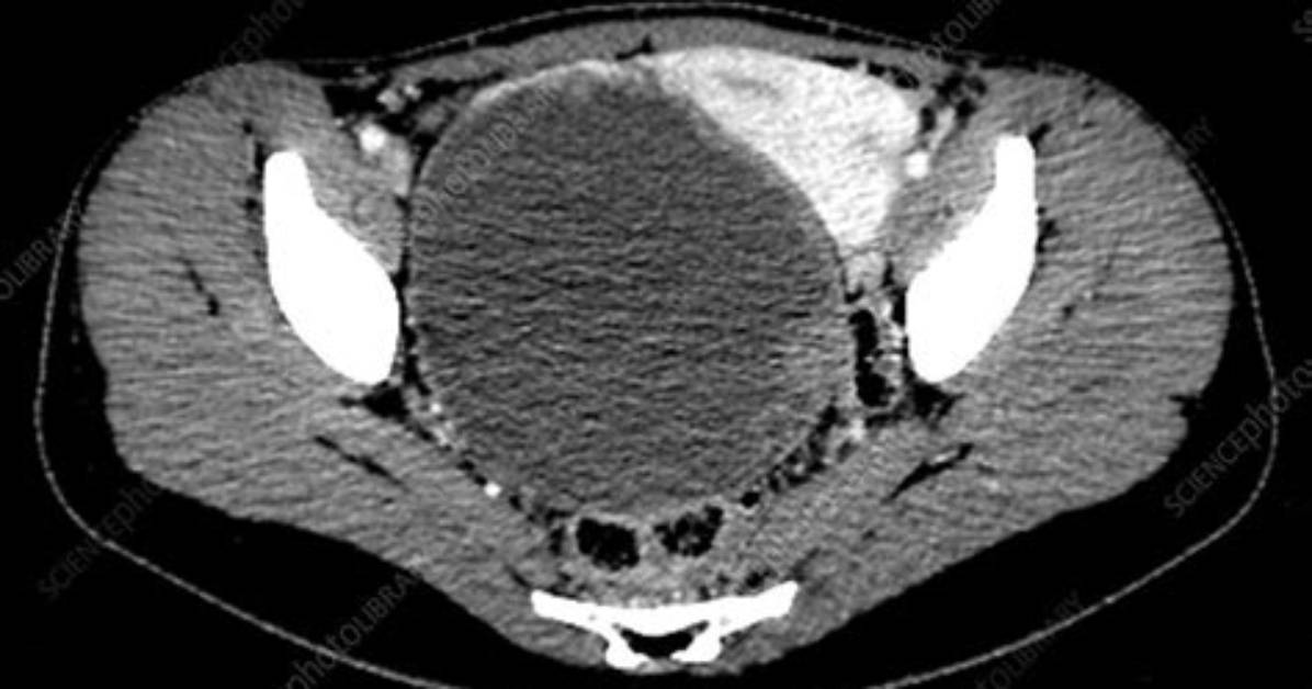 Would Ovarian Cancer Show on Ct Scan?