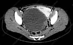 Would Ovarian Cancer Show on Ct Scan?