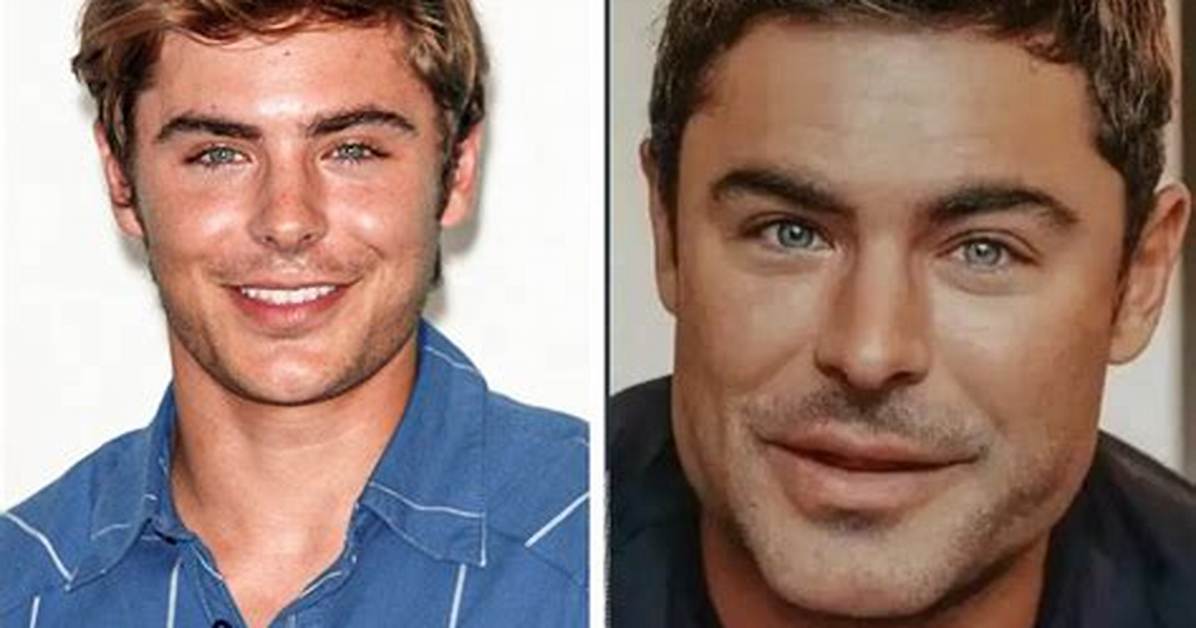 Zac Efron Plastic Surgery Video Before After Photos in 2022 Has He Gotten